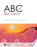 ABC of skin cancer