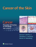 Cancer of the skin /