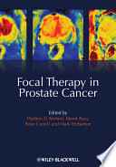 Focal therapy in prostate cancer